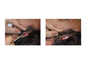 Extended Anterior Temporal Implants technique 3 Dr Barry Eppley Indianapolis