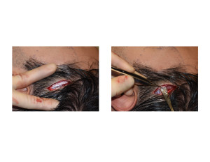 Extended Anterior Temporal Implants technique 4 Dr Barry Eppley Indianapolis
