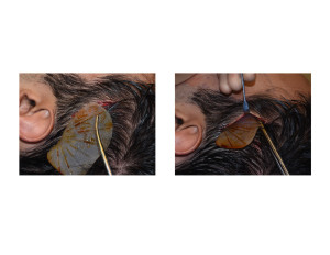 Extended Anterior Temporal Implants technique 5 Dr Barry Eppley Indianapolis