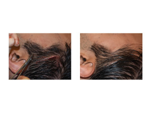 Extended Anterior Temporal Implants technique 6 Dr Barry Eppley Indianapolis