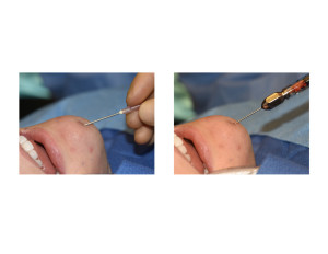 Fat Injection Chin Dimple technique fat injection Dr Barry Eppley Indianapolis