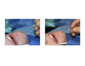 Fat Injection Chinj Dimple technique skin release Dr Barry Eppley Indianapolis