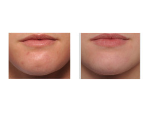 Fat Injections to Chin Dimple result front view Dr Barry Eppley Indianapolis