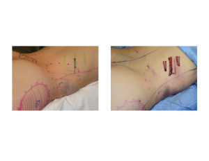 Lateral Waistline Rib Removal Dr Barry Eppley Indianapolis