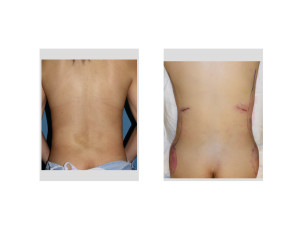 Lateral Wasitline Narrowing result intraop Dr Barry Eppley Indianapolis