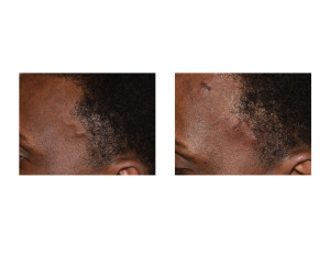 Left Temporal Artery LIgation immediate result Dr Barry Eppley Indianapolis