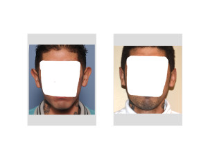 Macrotia and Otoplasty Ear Reconstruction result front view Dr Barry Eppley Indianapolis