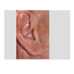 Male Facelift Scar