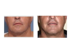 Male Lower Facelift result front view Dr Barry Eppley Indianapolis