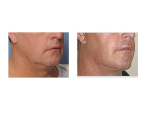 Male Lower Facelift result oblique view Dr Barry Eppley Indianapolis