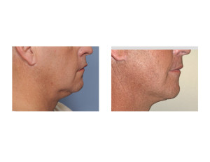Male Lower Facelift result side view Dr Barry Eppley Indianapolis