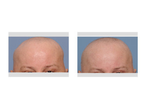 Revision Skull Reshaping result front view Dr Barry Eppley Indianapolis