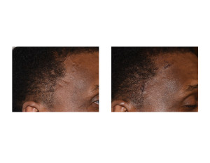 Right Temporal Artery LIgation immediate result Dr Barry Eppley Indianapolis