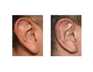 Right Vertical Ear Reduction result Dr Barry Eppley Indianapolis