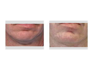 Square Chin Implant replacement result Dr Barry Eppley Indianapolis