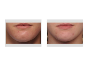Submental Chin Reduction Reshaping result front view Dr Barry Eppley Indianapolis