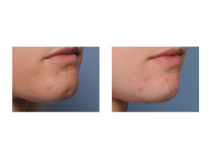 Submental Chin Reduction Reshaping result oblique view Dr Barry Eppley Indianapolis