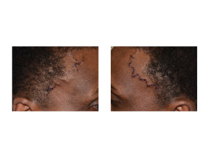 Temporal Artery LIgation mapping Dr Barry Eppley Indianapolis