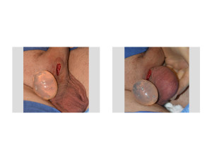 Testicular Implant intraoperative sizing Dr Barry Eppley Indianapolis