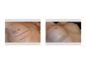 Transgender Breast Augmentation intraop result Dr Barry Eppley Indianapolis