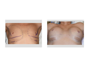 Transgender Bresat Augmentation intraop result 2 Dr Barry Eppley Indianapolis