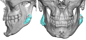 Bone Overgrowth Jaw Angle Implants Dr Barry Eppley Indianapolis
