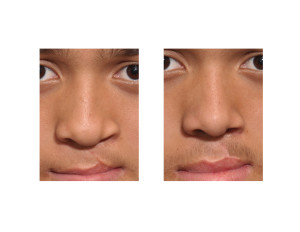 Cleft Rhinoplasty and Cleft Lip Revision result front view Dr Barry Eppley Indianapolis