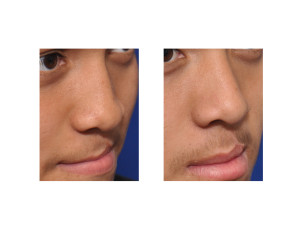Cleft Rhinoplasty and Cleft Lip Revision result oblique view Dr Barry Eppley Indianapolis