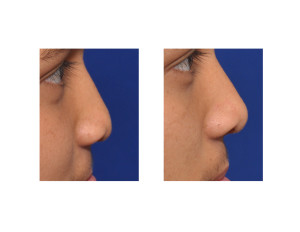 Cleft Rhinoplasty and Cleft Lip Revision result side view Dr Barry Eppley Indianapolis