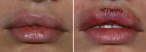 Cupid's Bow Excision before and after results Dr Barry Eppley Indianapolis
