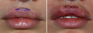 Cupid's Bow Excision intraop Dr Barry Eppley Indianapolis