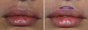 Cupid's Bow Reduction markings Dr Barry Eppley Indianapolis