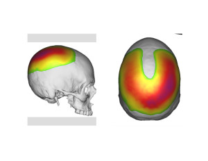 Head Widening Implant design thickness Dr Barry Eppley Indianapolis