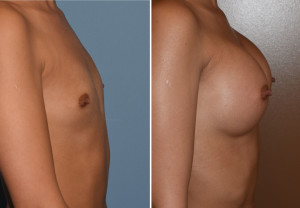 Hispanic Breast Augmentation result side view Dr Barry Eppley Indianapolis