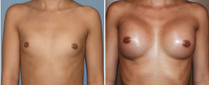 Hispanic Breast Augmentation results front view Dr Barry Eppley Indianapolis