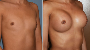 Hispanic Breast Augmentation results obique view Dr Barry Epley Indianapolis