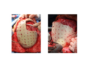 JA PEKK Implant removal process