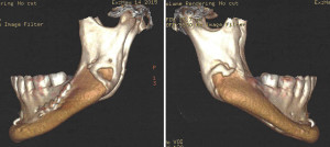 Jaw Angle Implant Bony Overgrowth Dr Barry Eppley Indianapolis