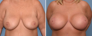 Large Breast Implants with Lift result front view