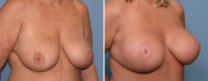 Large Breast Implants with Lift result oblique view