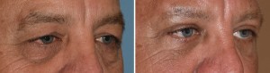 Male Transpalpebral Browlift results oblique view Dr Barry Eppley Indianapolis
