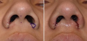 Nostril Narrowing intraop result Dr Barry Eppley Indianapolis