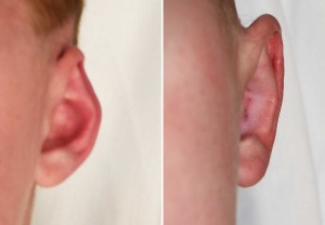 Reversal Otoplasty result front view Dr Barry Eppley Indianapolis