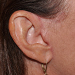 Short Scar Facelift Dr Barry Eppley Indianapolis
