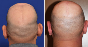Total Skull Implant reconstruction results back view Dr Barry Eppley Indianapolis