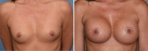 Breast Implants and Cleavage result front view Dr Barry Eppley Indianapolis