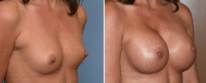 Breast Implants and Cleavage results oblique view Dr Barry Eppley Indianapolis