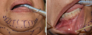 Chin Implant Malposition Dr Barry Eppley Indianapolis
