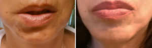 Chin Implant Revision Surgery results Dr Barry Eppley Indianapolis