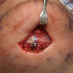 Chin Implant Revision with Screw Fixation Dr Barry Eppley Indianapolis